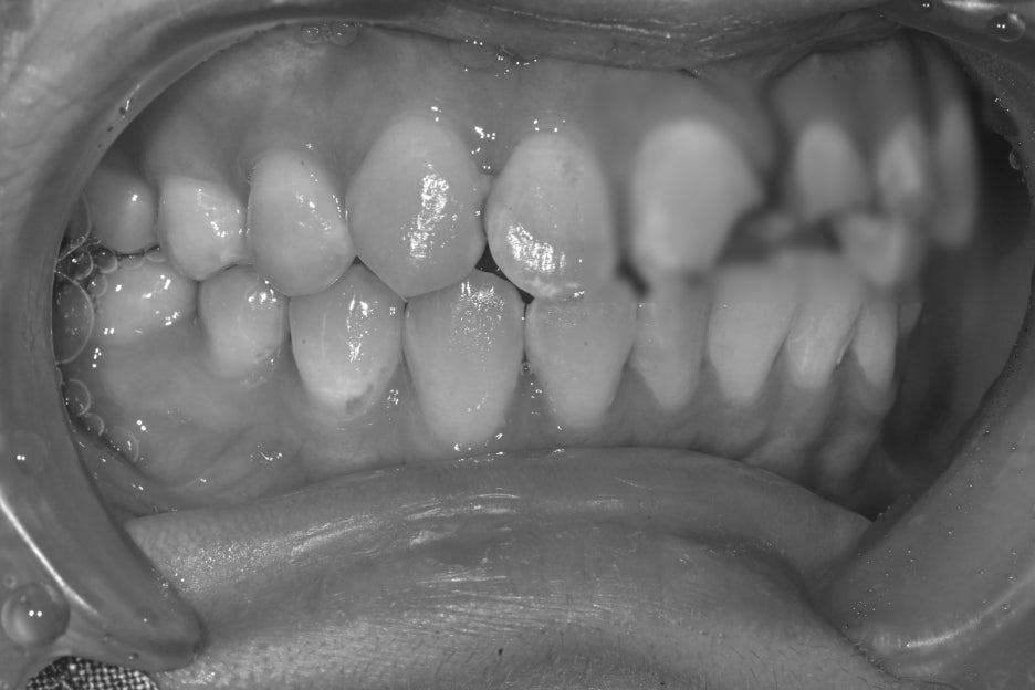 Songpa Dental Clinic, a Case of Crown Restoration After Root Canal Treatment for a Woman in Her 20s With a Broken Front Tooth image 7