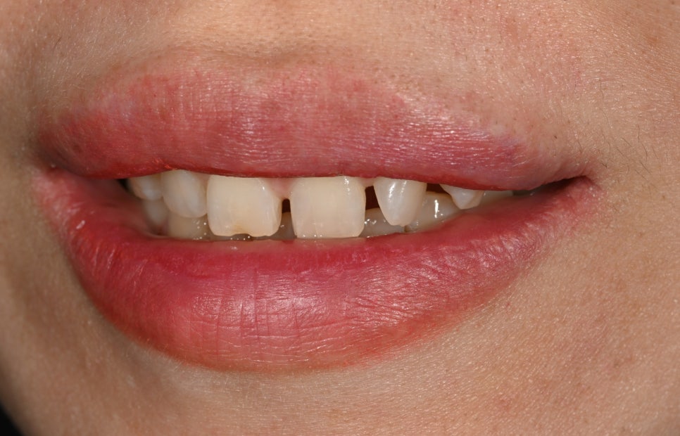 Can Gaps Between the Front Teeth Be Treated with Composite Resin? A Case Treated with Veneers image 5