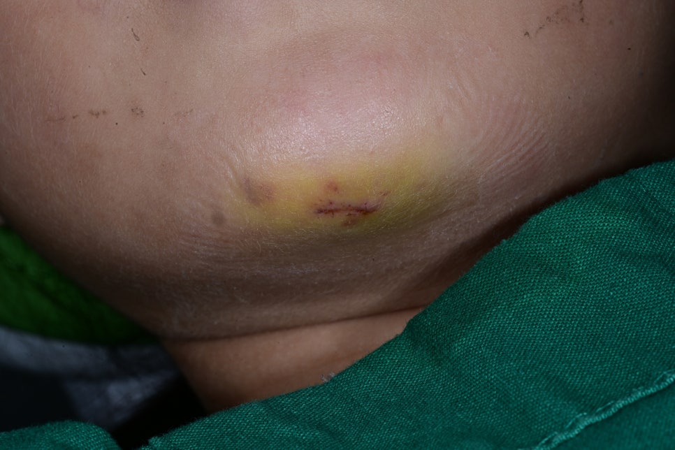 Pediatric Jaw Trauma: Can It Be Treated at a Dental Clinic Instead of a Plastic Surgery Clinic? See the Real Case image 4