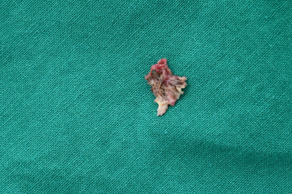 Songpa-gu Front Tooth Implant: Is It Possible Even in an Inflamed Area? image 5