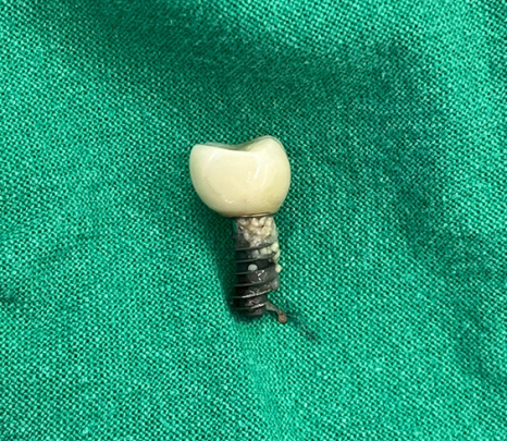 Samjeon Station Implant: Why do some break while others can last a lifetime? image 7