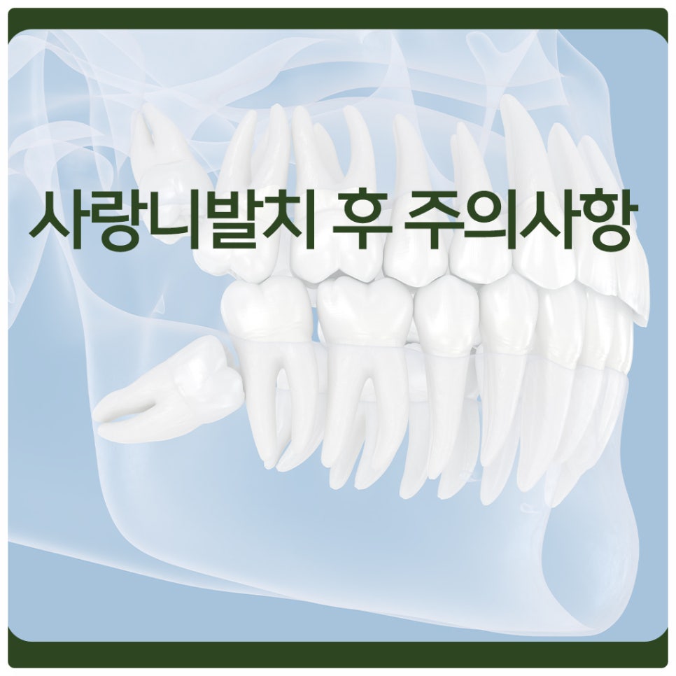 사랑니발치 후 주의사항, 잘 지켜주시어 빠르게 회복하세요! 관련 이미지 1