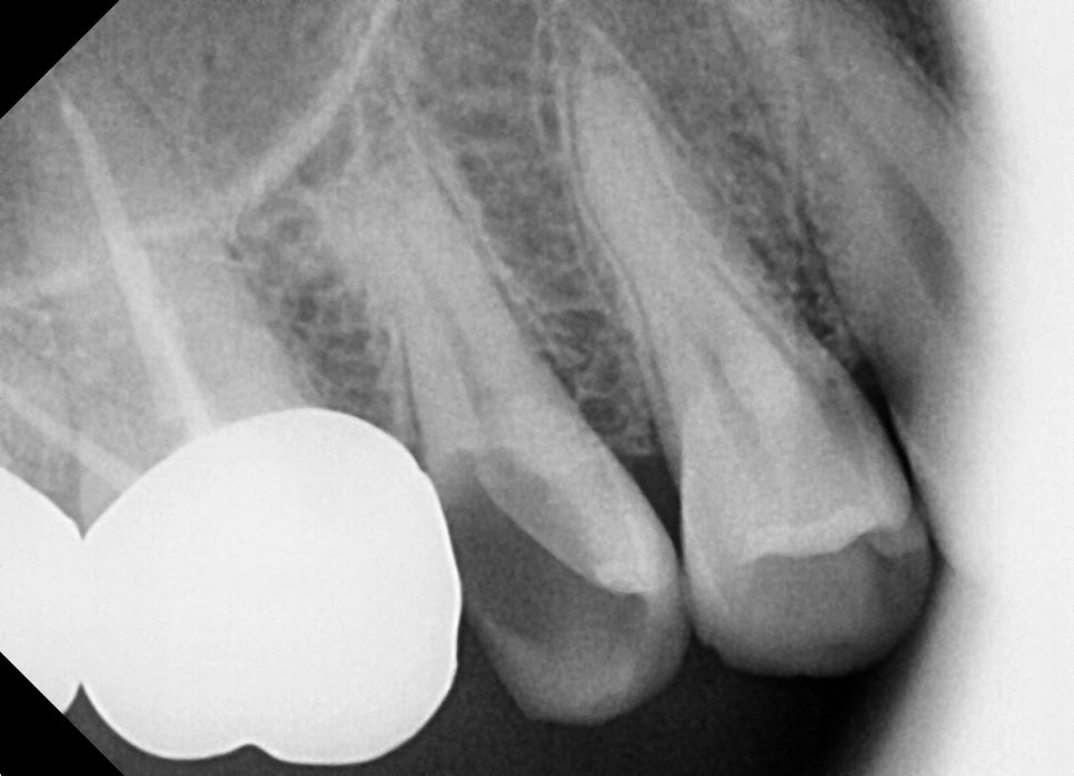 When a molar breaks, do you always need an implant? image 15