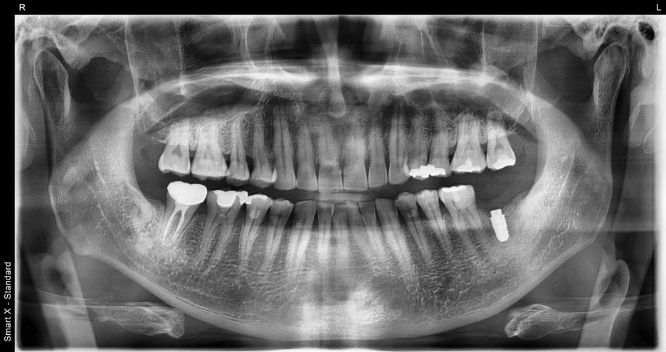 Jamsil Dental Hospital Implant Price and Treatment Case image 11