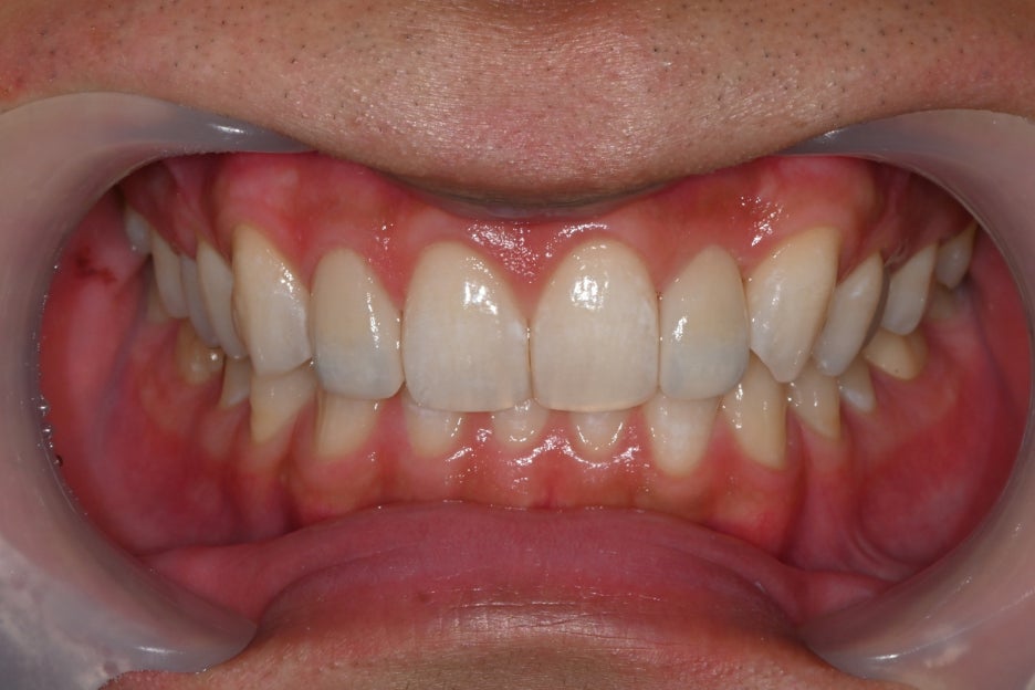 Object Zero Front Tooth Laminate, Minimizing Tooth Reduction image 32