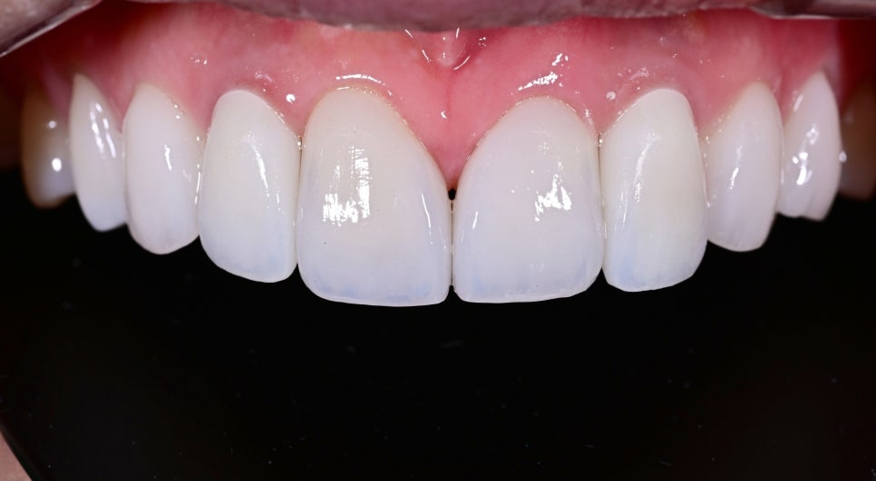A Case of Simultaneous Laminate and Implant Prosthetic Treatment image 1