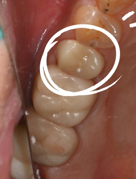 When a molar breaks, do you always need an implant? image 21