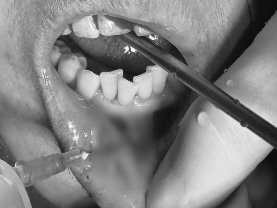 Treatment Process Revealed for a Fall That Injured Both the Front Teeth and Lip image 10