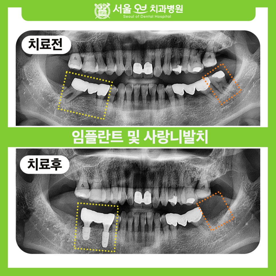 [Seokchon Gobun Station Dental Clinic] When Is an Implant Needed? image 1