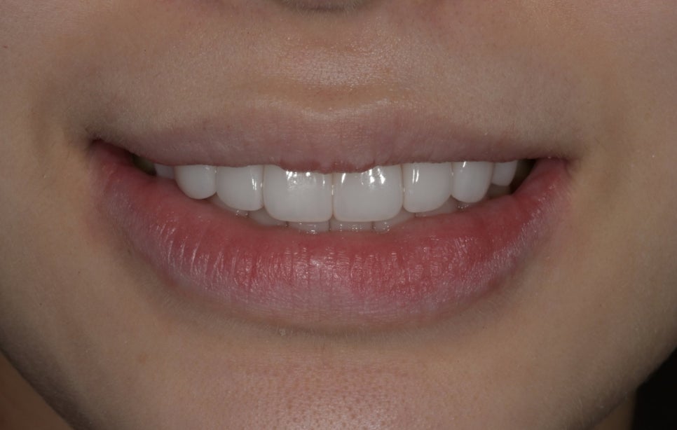 Canine Veneers Without Orthodontic Treatment image 12
