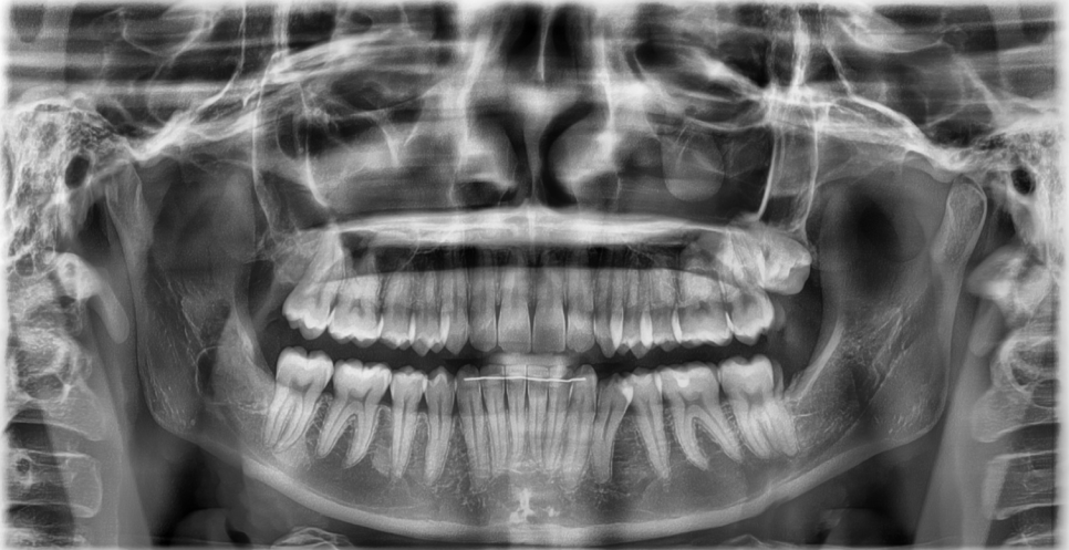 Jamsil Wisdom Tooth Extraction: If It Doesn’t Hurt, Is It Okay to Keep Putting It Off? image 4