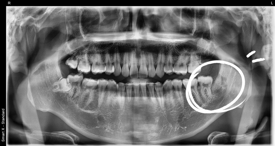 Cysts, If Left Untreated, Can Even Dissolve Bone. Introduction to an Accurate Diagnosis and Surgical Case image 8