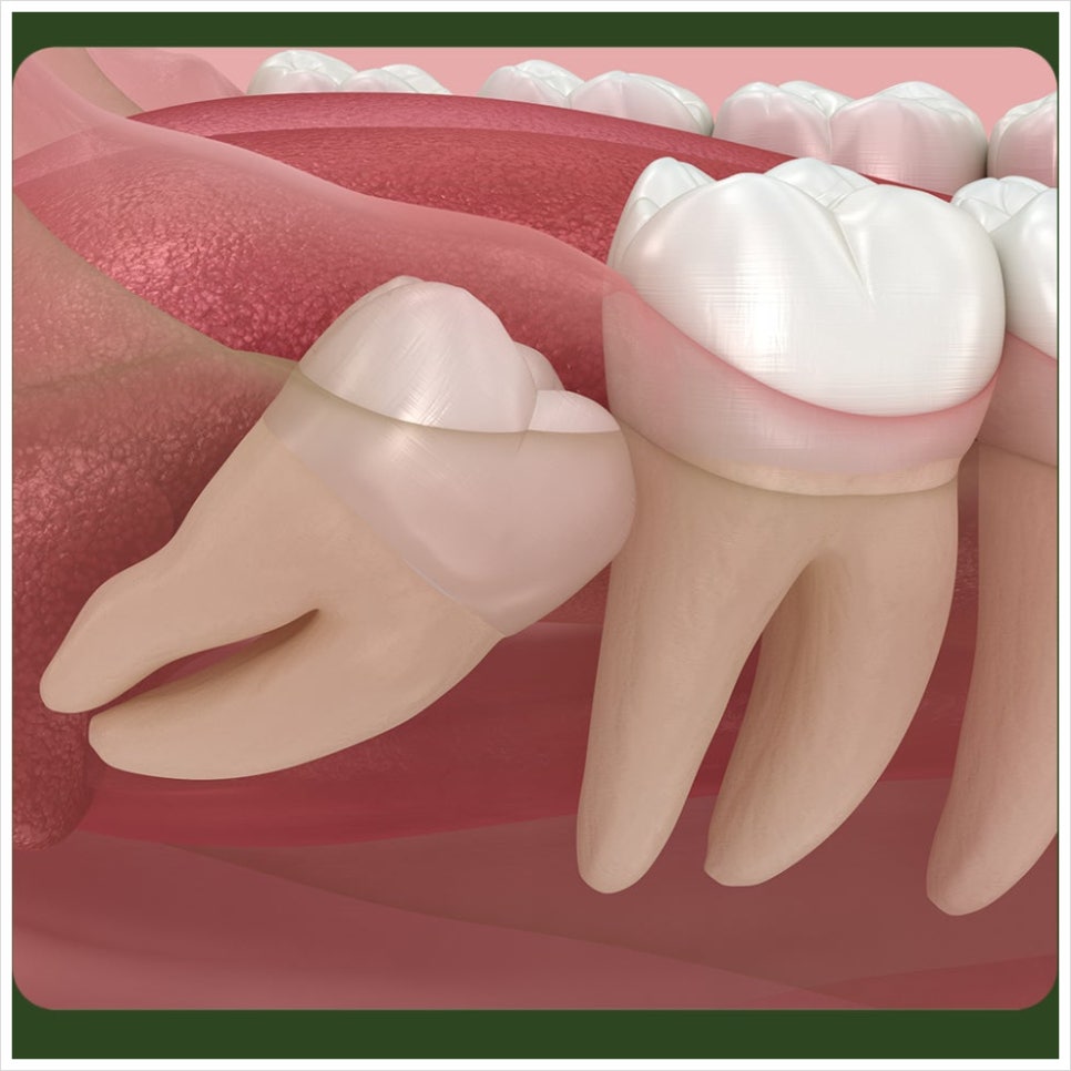 Why Should You Be Careful with Straws After Wisdom Tooth Extraction? image 2