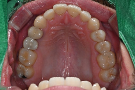 Implant Treatment Available for Foreign Residents Abroad! A Case Completed Perfectly Within 3 Months image 7