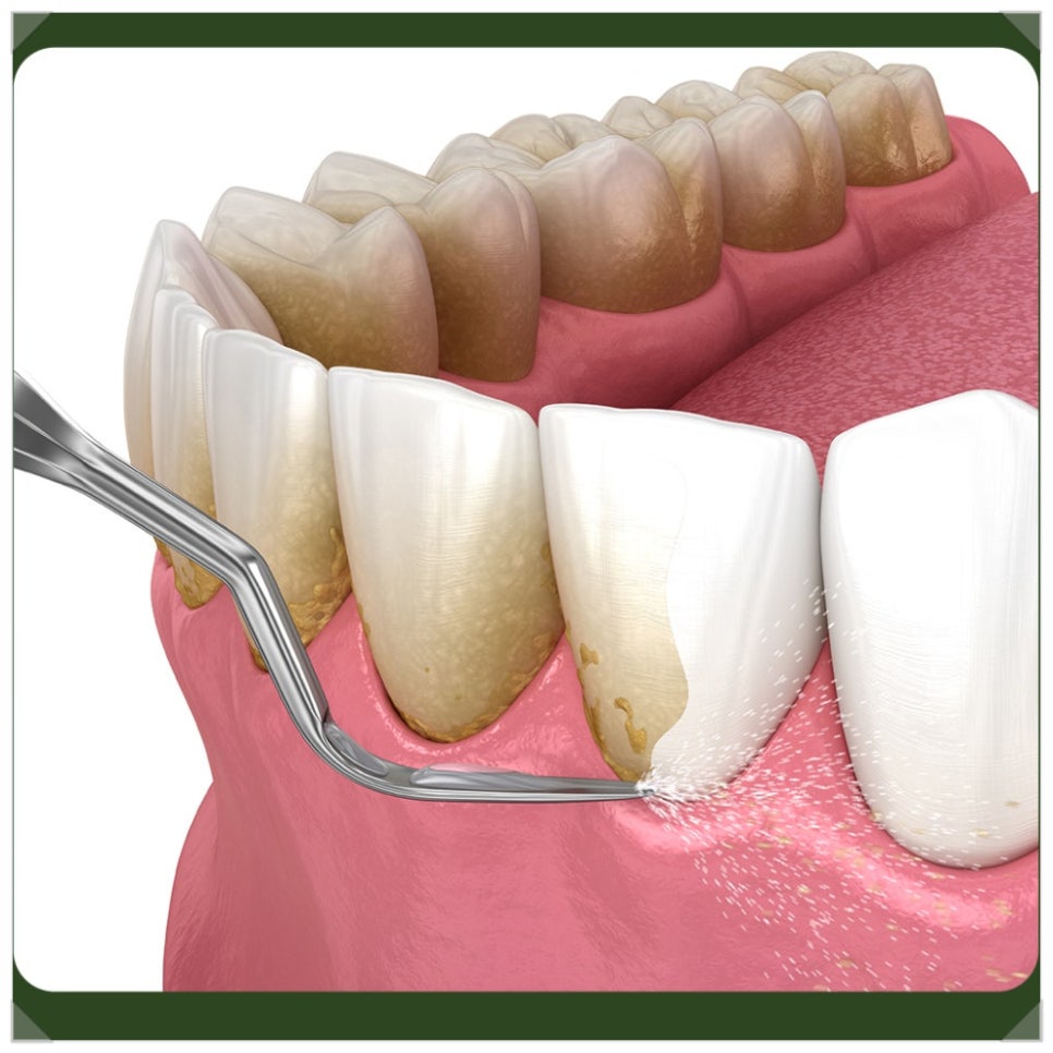 Bleeding After Scaling—Is Something Wrong with the Treatment? If You're Worried image 4