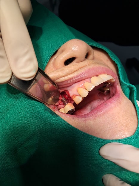 Implants Possible Even in Your 90s: Real Cases from Seoul Above Dental Clinic! image 4