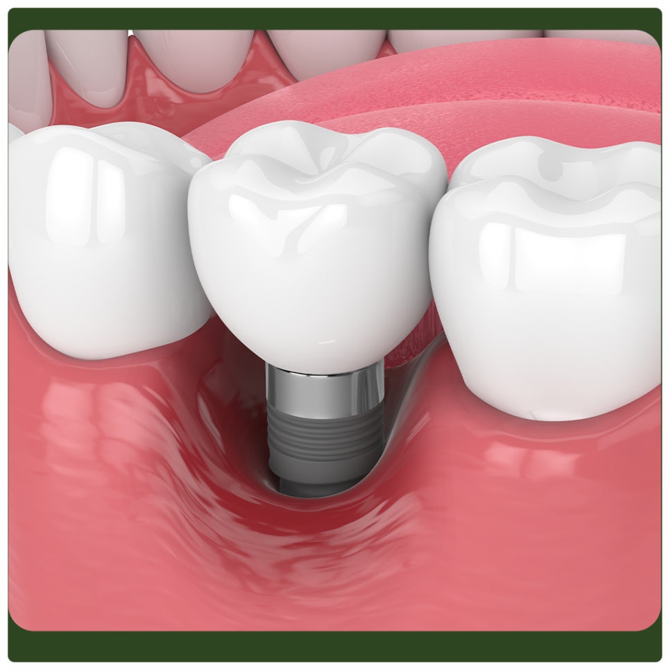Peri-Implantitis: Proper Care Is Needed to Prevent It! image 4