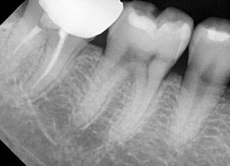 Inlay Treatment Review in Songpa-gu, Seoul – Completed in 1 Week with Precision Scanning and Lab Work image 4