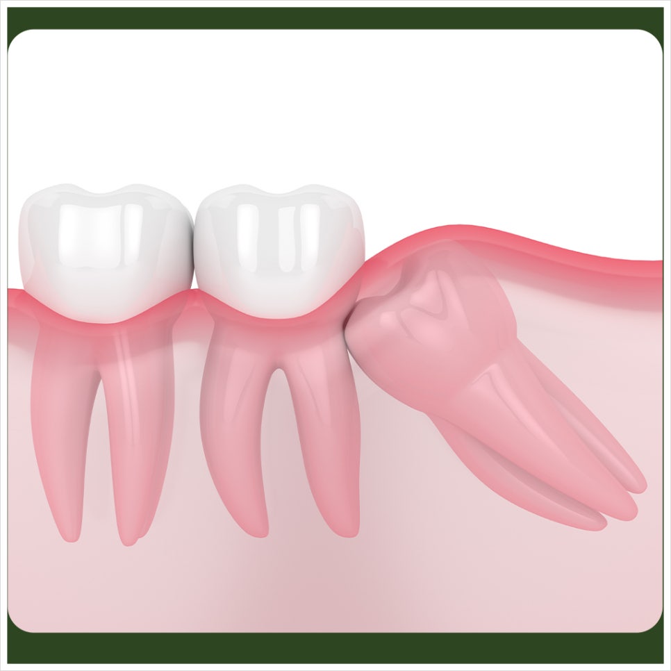 Why Should You Be Careful About Smoking After Wisdom Tooth Extraction? image 5