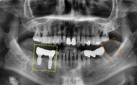 [Seokchon Gobun Station Dental Clinic] When Is an Implant Needed? image 10