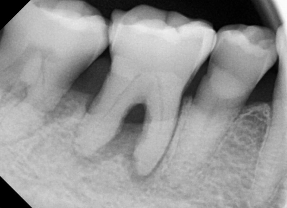 Understanding Implant Price Differences Through the Molar Implant Process image 8