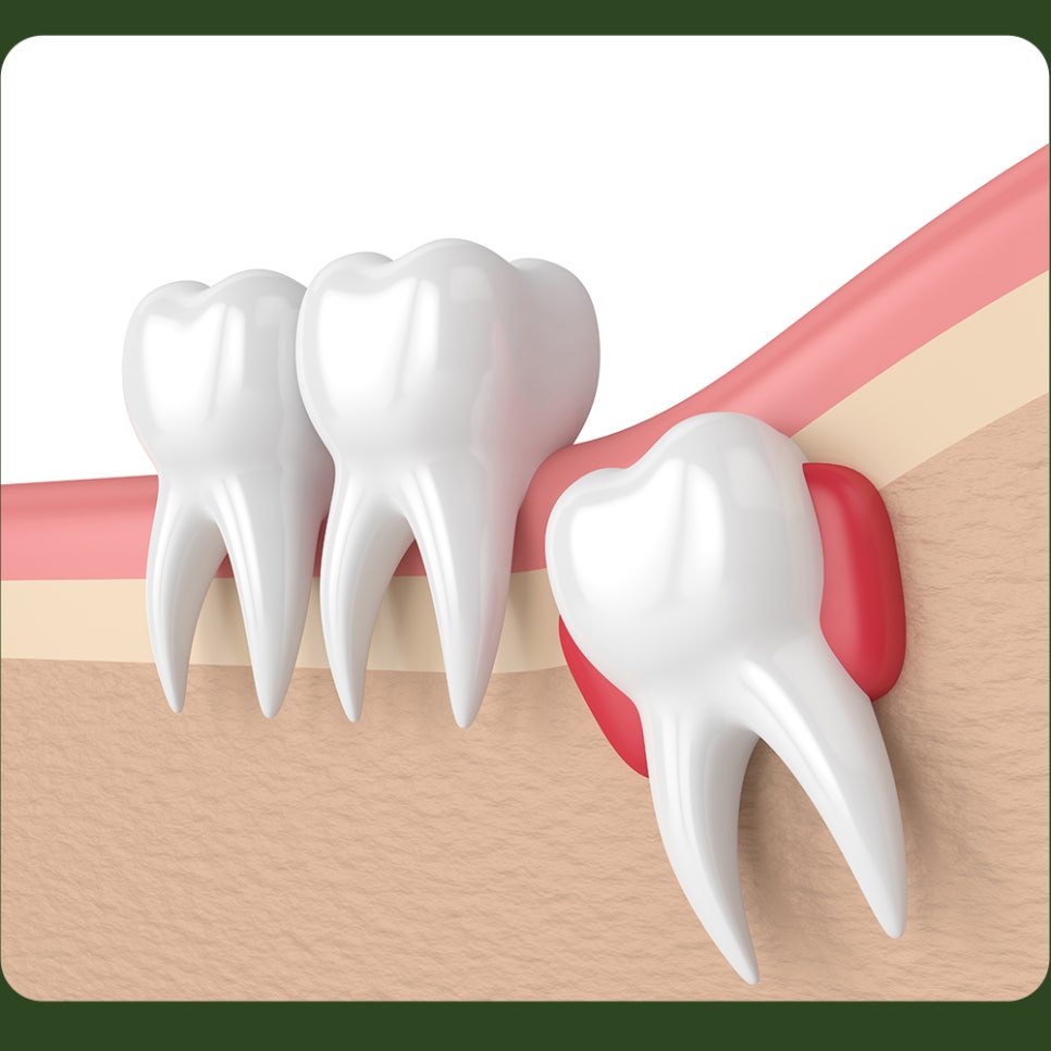 After Wisdom Tooth Extraction, How Long Should You Keep Biting on the Gauze? image 2