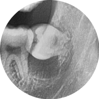 Cysts, If Left Untreated, Can Even Dissolve Bone. Introduction to an Accurate Diagnosis and Surgical Case image 3