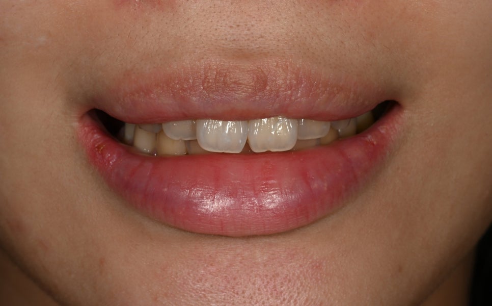 Jamsil Veneers: Worried About Rabbit Teeth? image 2