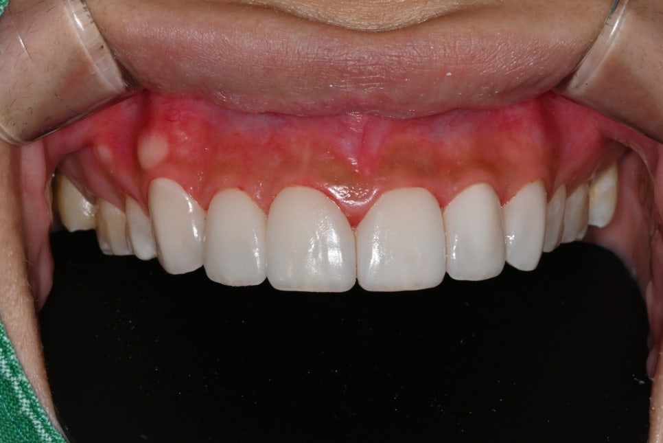 Samjeon Station Dental Clinic: "Without Orthodontics, Object Zero for the Smile Line of a Woman in Her 20s" image 10