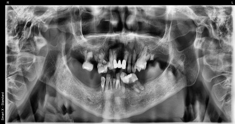 How Are Snap-On Dentures and Full-Mouth Implant Costs Handled at an Implant Dental Clinic? image 4