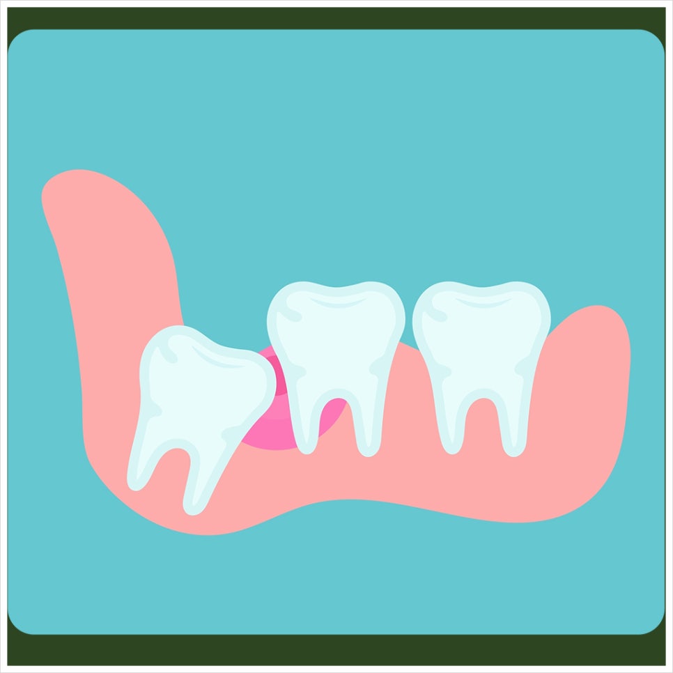 Swelling After Wisdom Tooth Extraction: How Can You Reduce It Quickly? image 4