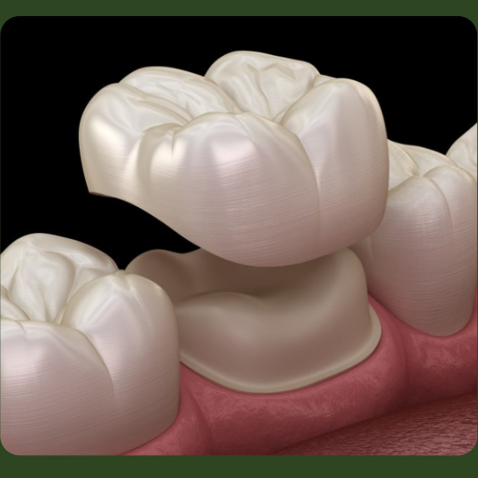 Crown loosening: if you can feel it and there’s a smell, what does it mean? image 2