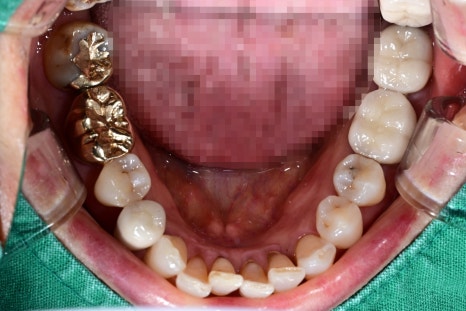 Is an Implant Price Really Worth Trusting? image 11