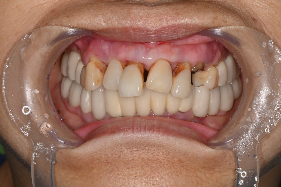 Front Tooth Implant Price: This Is How It Is Treated for a Natural Recovery image 6