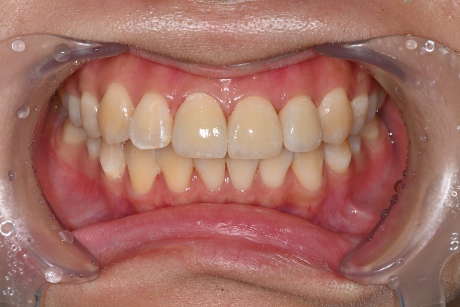 Songpa Dental Clinic, a Case of Crown Restoration After Root Canal Treatment for a Woman in Her 20s With a Broken Front Tooth image 15