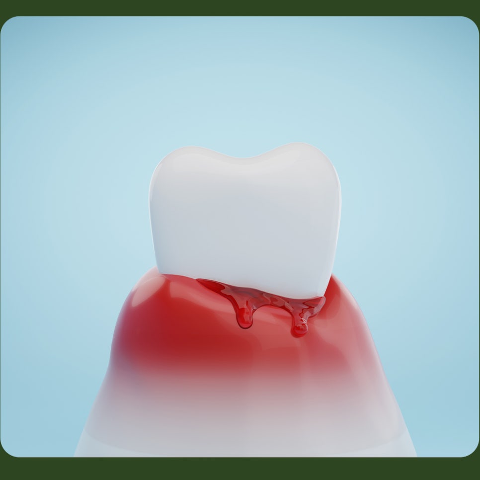 Why Do Gums Bleed? image 5