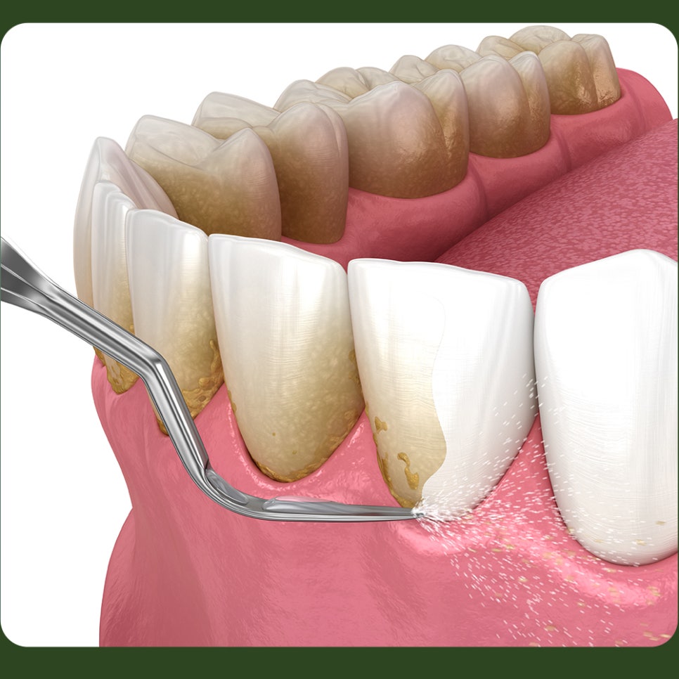 Why Do Gums Bleed? image 4