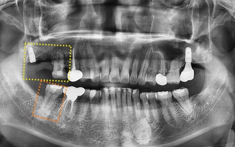 Songpa-gu Dental Clinic: Solving a Case Where Prosthetics Were Impossible with Implant Reoperation! image 14