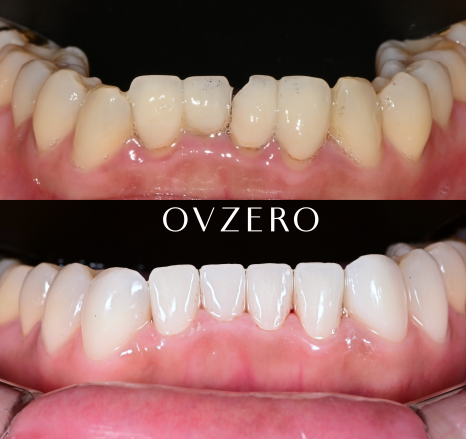 Objeo Laminate Price, and How It Differs from No-Prep Laminate image 5