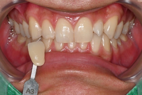 Do Men Get Laminates Too? The Choice of a Man in His 20s Who Became Naturally More Attractive image 2