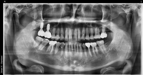 Things You Must Check Before Implant Treatment image 25