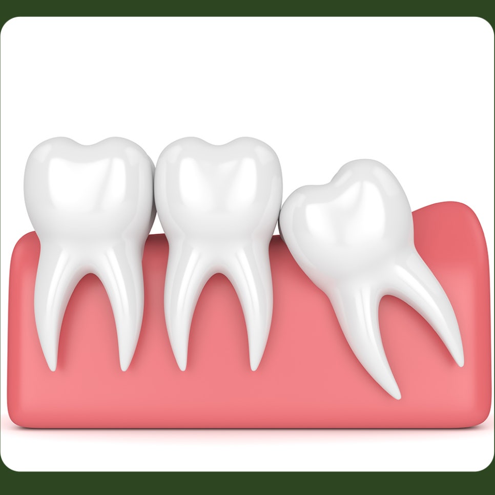 After Wisdom Tooth Extraction, How Long Should You Keep Biting on the Gauze? image 5