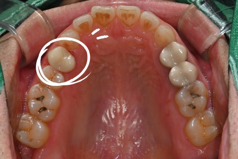 Why Cracked Molar Pain Means You May Need Root Canal Treatment image 9