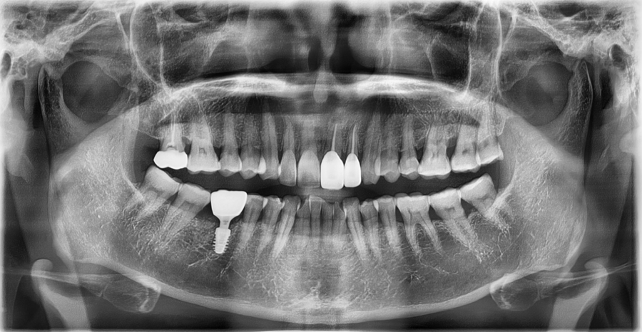 How Was Sensitivity and Discomfort Resolved After Implant Treatment in Jamsil? image 14