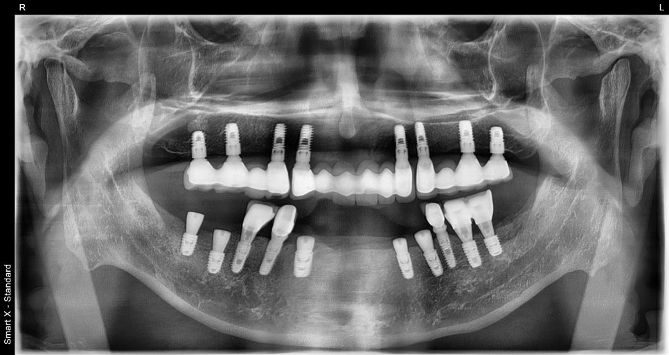 Immediate Implant Placement After Extraction! Seoulove Dental’s Fast Full-Mouth Implant Treatment Completed in 4 Months image 5