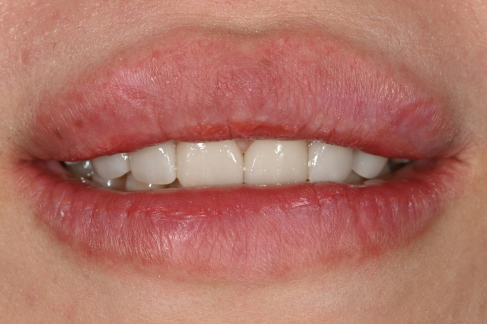 Can Gaps Between the Front Teeth Be Treated with Composite Resin? A Case Treated with Veneers image 7