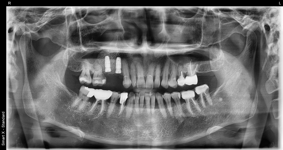 Is an Implant Price Really Worth Trusting? image 16