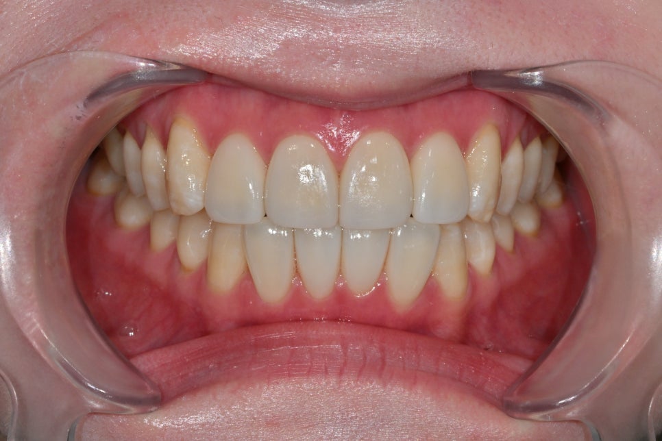 Songpa Dental Clinic: A Case of Improving Mottled Teeth with Veneers image 7