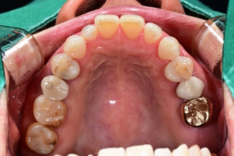 Is an Implant Price Really Worth Trusting? image 10