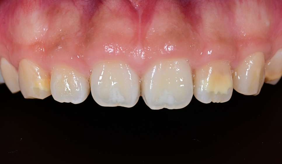 Samjeon Station Dental Clinic: A Case of Improving Discolored Teeth with No-Prep Ove Zero Laminates image 4